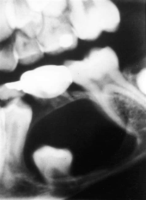 Odontogenic Cysts Related To Pulpotomized Deciduous Molarsclinical