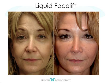 Liquid Facelifts Houston Tx Refresh Dermatology
