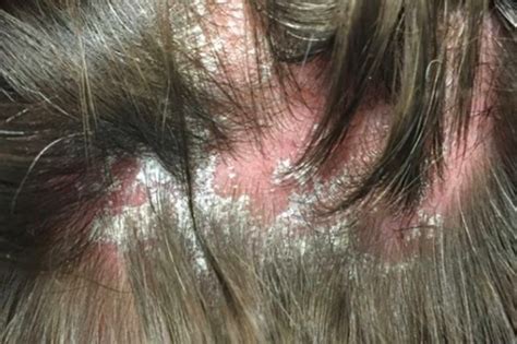 Can Psoriasis Also Cause Scarring — Donovan Hair Clinic