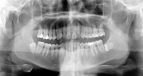Dental X Rays Are Safe Effective And They Dont Cause Cancer Mead