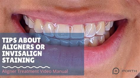 Tips About Aligners Or Invisalign Staining Youtube