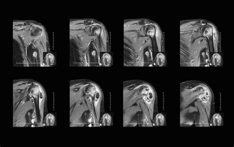 Arthrogram Joint Imaging American Health Imaging Mri Ct