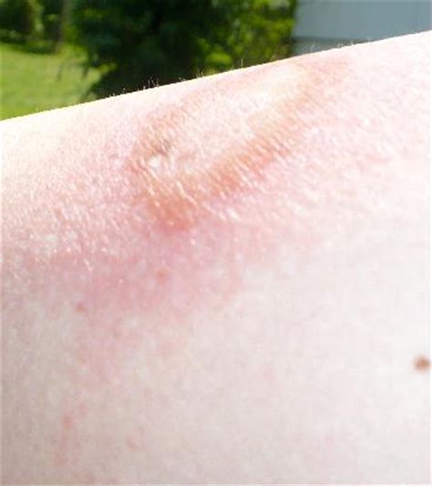SHINGLES-STORY