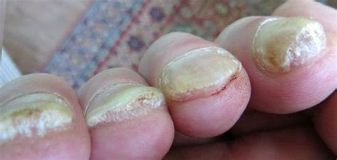 Are oral medications for nail fungus toxic? Toenail fungus cure: Best yellow toenails treatment