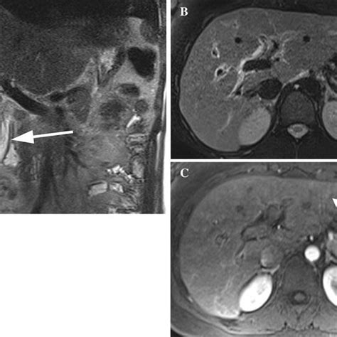 A 25 Year Old Woman With Severe Right Upper Quadrant Pain Gallstones