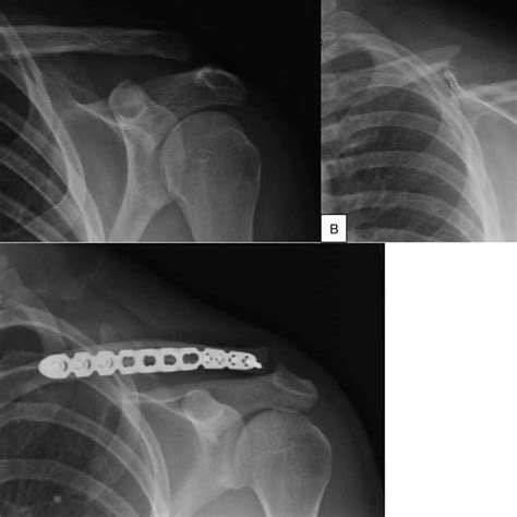 Radiographs Of Normal Clavicle Clavicle Fracture And Clavicle