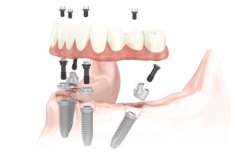 Dr Arthur Glosman How Does All In One Dental Implants