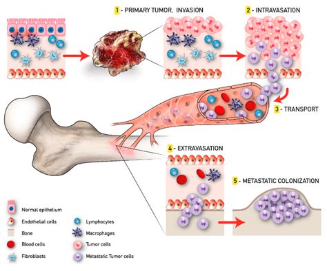 Cancers Free Full Text Trends In Bone Metastasis Modeling