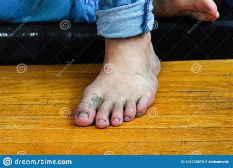 Closeup Of A Foot With Dirty Toes Stock Photo Image Of Foot Stink