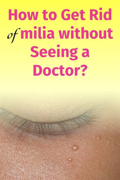How To Get Rid Of Milia Without Seeing A Doctor White Bumps On Face