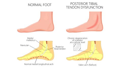 Posterior Tibial Tendon Dysfunction Pttd East Coast Podiatry