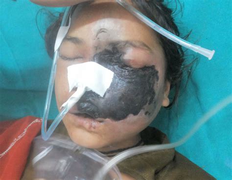 Complaining of pain and swelling of left side of face with left eye vission. Rhinocerebral mucormycosis in a patient with type 1 ...