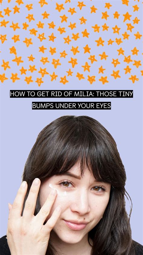 How To Get Rid Of Milia Tiny White Bumps Under Eyes The Klog Bumps