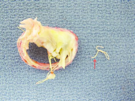 View Of The Mitral Valve And Physio Annuloplasty Ring After Removal
