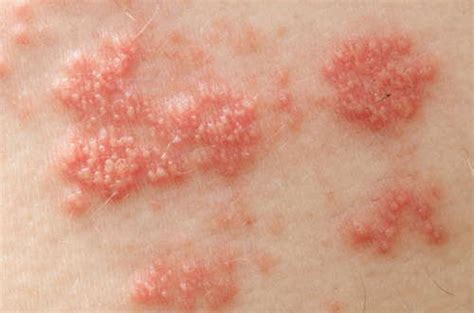 Lupus Butterfly Rash Pictures Medical Pictures And Images 2021