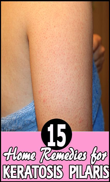 Keratosis Pilaris On Face Home Remedies Anti Aging And Young