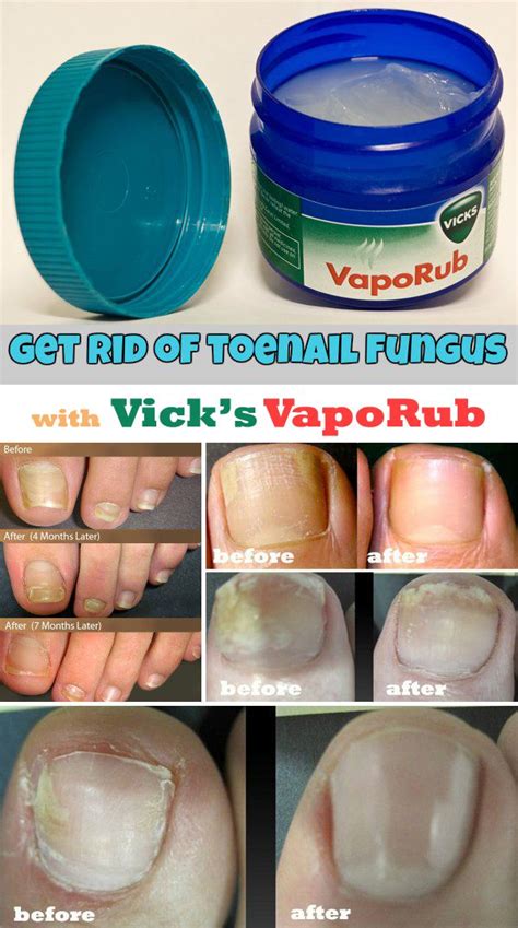 Mentholated salves contain the natural ingredients menthol, eucalyptus oil, and. Surprising Uses of Vicks VapoRub | Nail fungus cure ...
