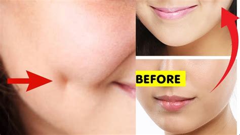How To Get Dimples Fast And Naturally Simple Facial Exercises To Get Dimples Without Surgery