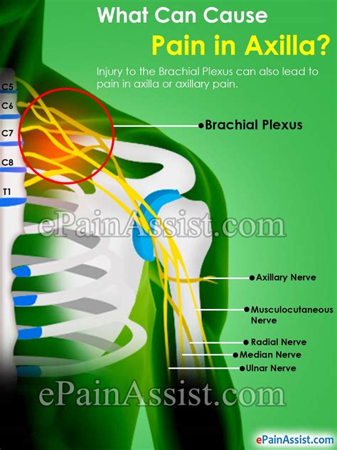 What Can Cause Pain In Axilla And How Is It Treated