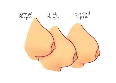 Inverted Nipple Correction Surgery Cost