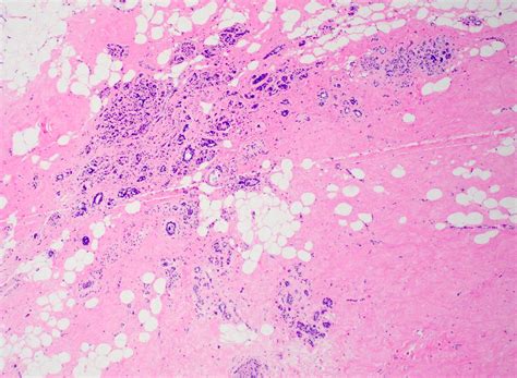 Pathology Outlines Sclerosing Adenosis