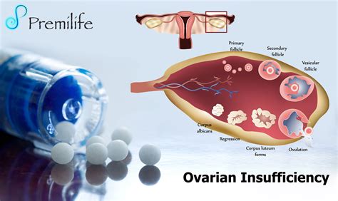 Ovarian Insufficiency Premilife Homeopathic Remedies