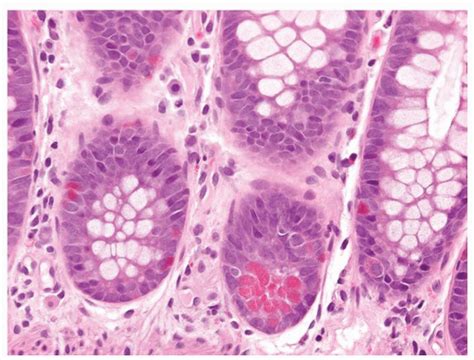 Disorders of Endocrine Cells | Abdominal Key