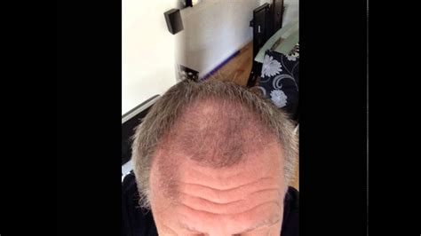 2000 Fue Before And After 22 Weeks Transplant Patient Diary Uk Hair Transplant Clinics Youtube