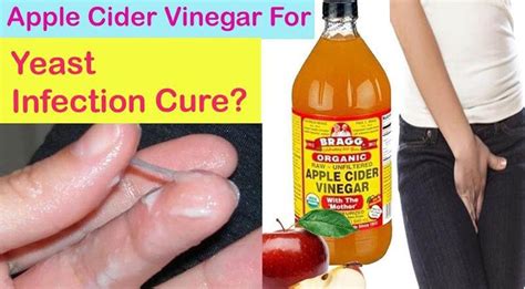Apple cider vinegar is a type of vinegar made from fermented apple juice. How To Use Apple Cider Vinegar For Yeast Infection ...