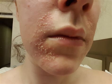 Cystic acne usually appears on the face, shoulders, back and chest. What has happened to my face on holiday?! - General acne ...