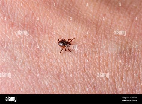 Tick On Human Skin Closeup Of A Parasite Arachnid Walking On The