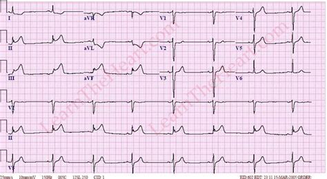 Inferior Wall Myocardial Infarction Mi Ecg Example Learn The Heart