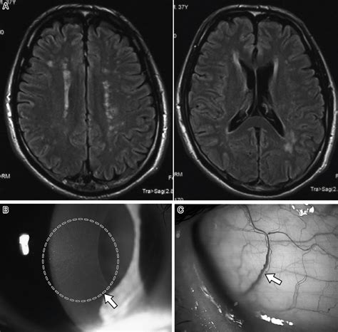 Brain Magnetic Resonance Image Mri And Ocular Findings A T2 Weighted Download Scientific