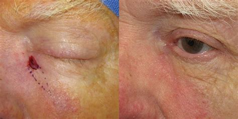 Reconstructive Surgery Skin Cancer Eyelid Orange County Skin Cancer