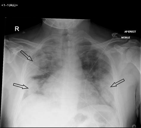 The Role Of Chest Radiography In Confirming Covid Pneumonia The Bmj