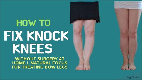 How To Fix Knock Knees In Adults Without Surgery Qqmcuo