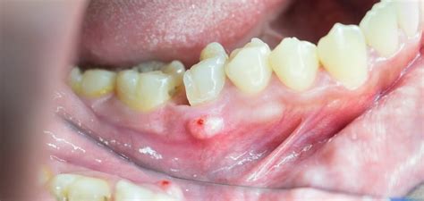 Parulis Fistula Dental Abscess Treatment And Symptoms Maiden Lane