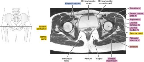 Mri Female Pelvis Anatomy Axial Image Pelvis Anatom Vrogue Co