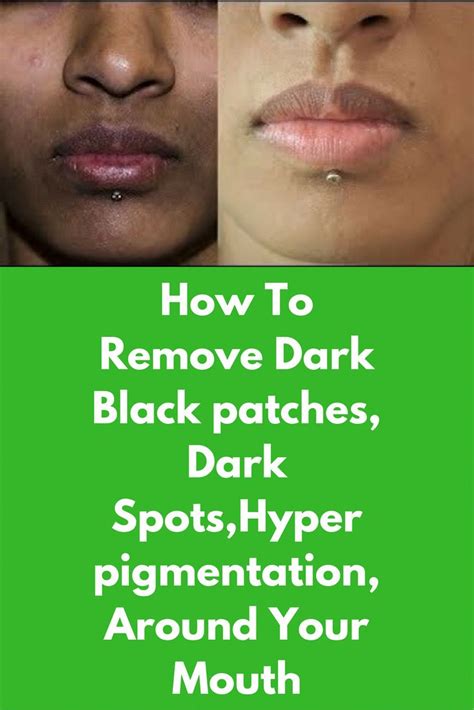 How To Remove Dark Black Patches Dark Spotshyper Pigmentation Around