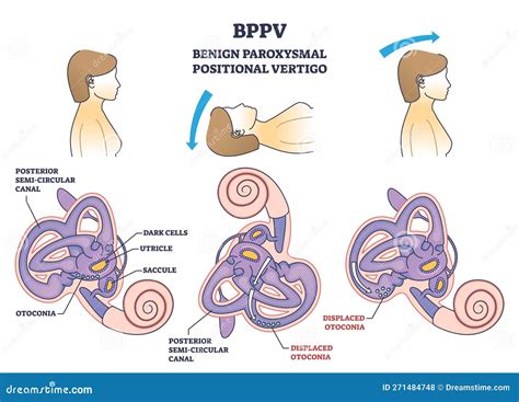 Bppv Or Benign Paroxysmal Positional Vertigo Syndrome Outline Diagram