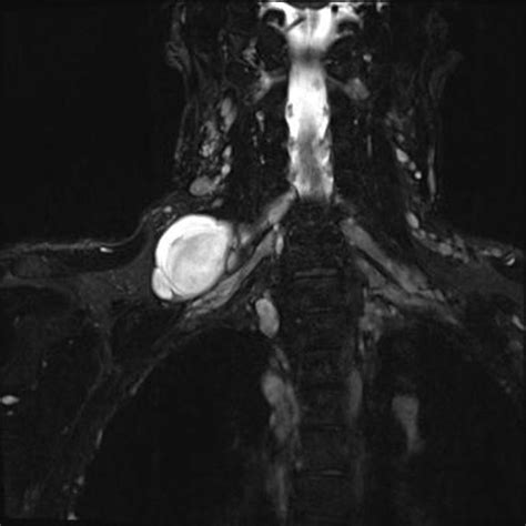 Neurofibromatosis With Brachial Plexus Neurofibroma Radiology Case