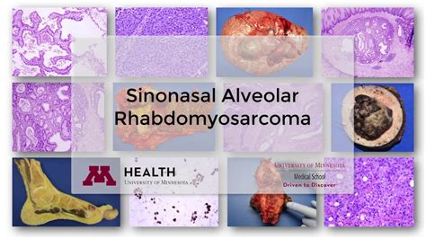 Alveolar Rhabdomyosarcoma - YouTube