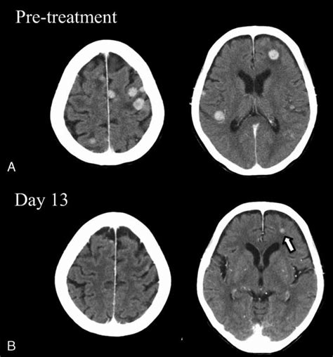 Contrast Enhanced Axial Brain Ct Images Of Case 1 Multiple Metastases