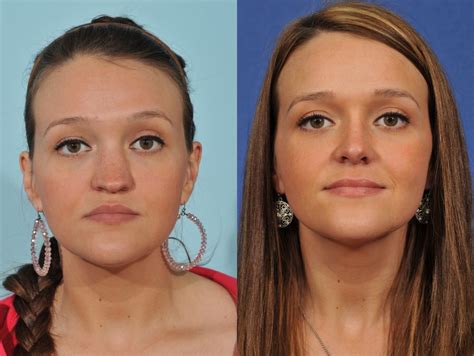Rhinoplasty Before And After 3 Jesse E Smith Md Facs Ft Worth