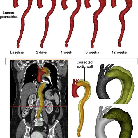 Stanford And Debakey Classifications Of Aortic Dissection Figure From
