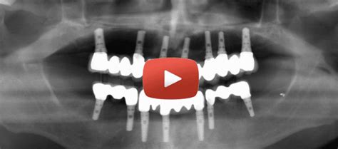 Full Mouth Dental Implants Burbanks Ramsey Amin Dds Review Video