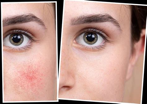 Rosacea Skincare • Treat The Redness • Nascent Skin Clinic Shop