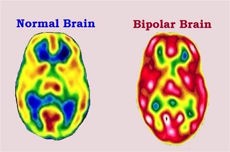 Bipolar Disorder Symptoms Types Causes And Complications How To