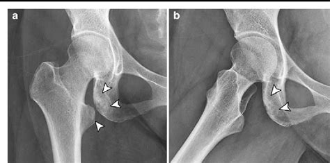 Impingement Of Lesser Trochanter On Ischium As A Potential Cause For