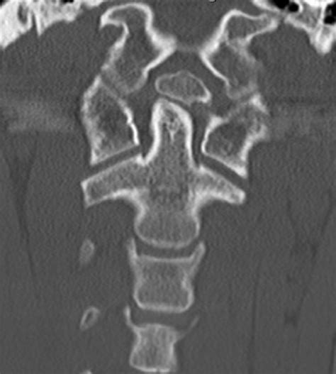 Os Odontoideum Radiology Case